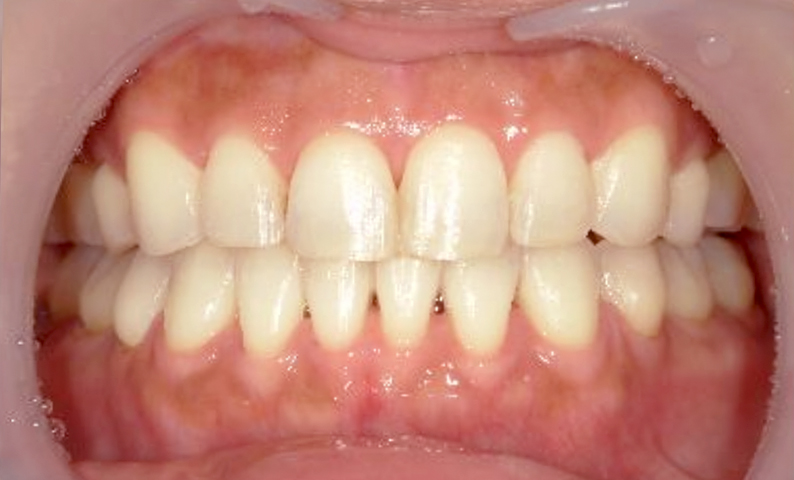 部分矯正 40代の症例写真