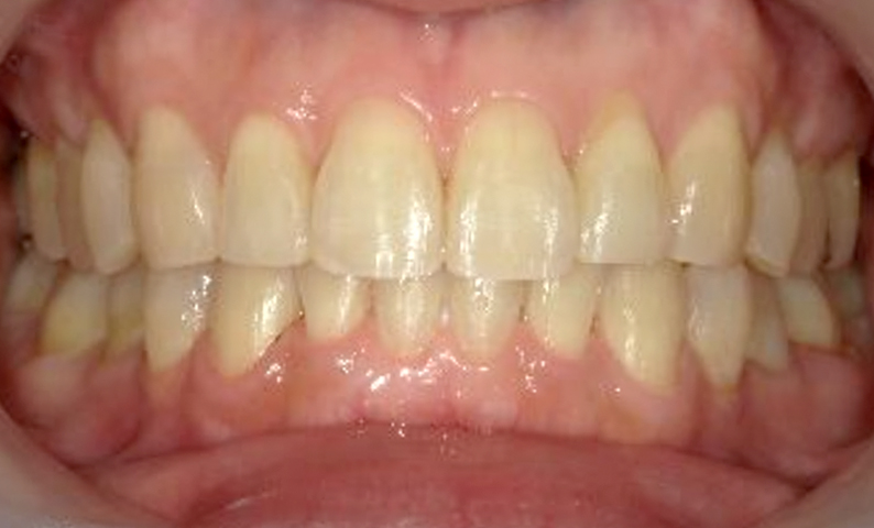 部分矯正 40代の症例写真