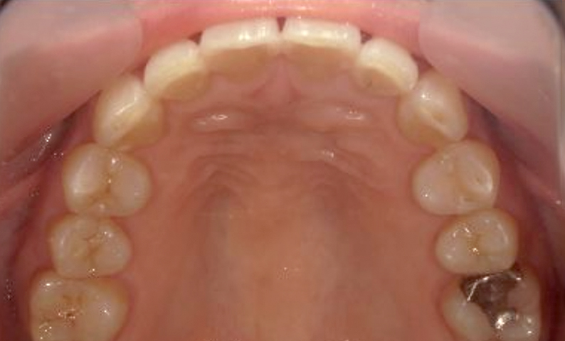 部分矯正 40代の症例写真