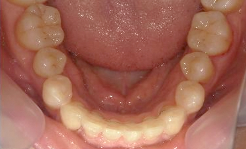 部分矯正 40代の症例写真