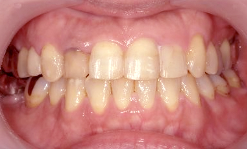 部分矯正 40代の症例写真