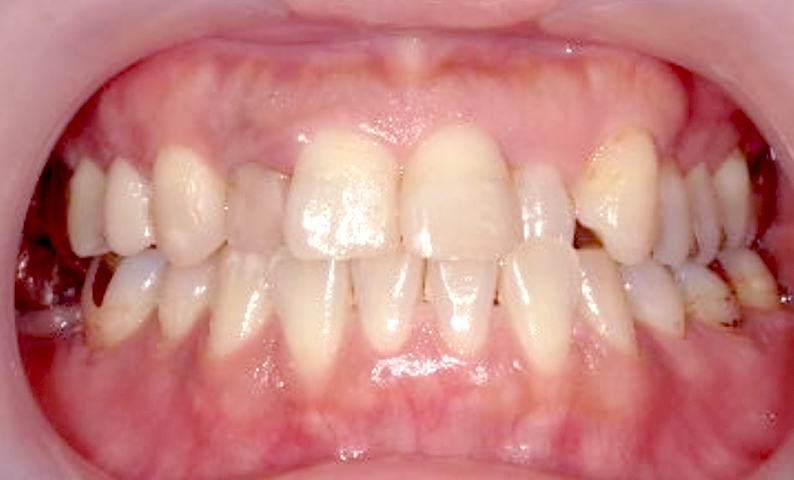 部分矯正 40代の症例写真