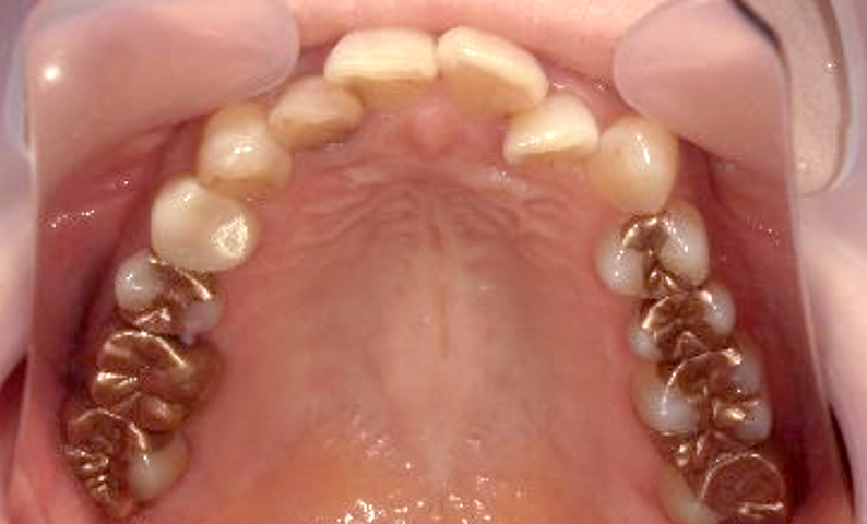 部分矯正 40代の症例写真