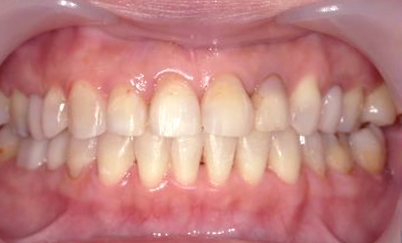 部分矯正 40代の症例写真