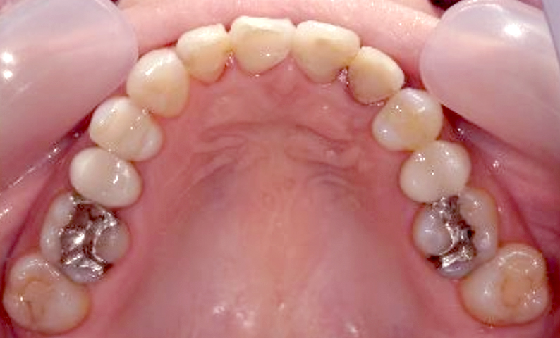 部分矯正 40代の症例写真