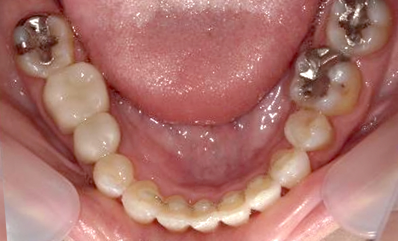 部分矯正 40代の症例写真