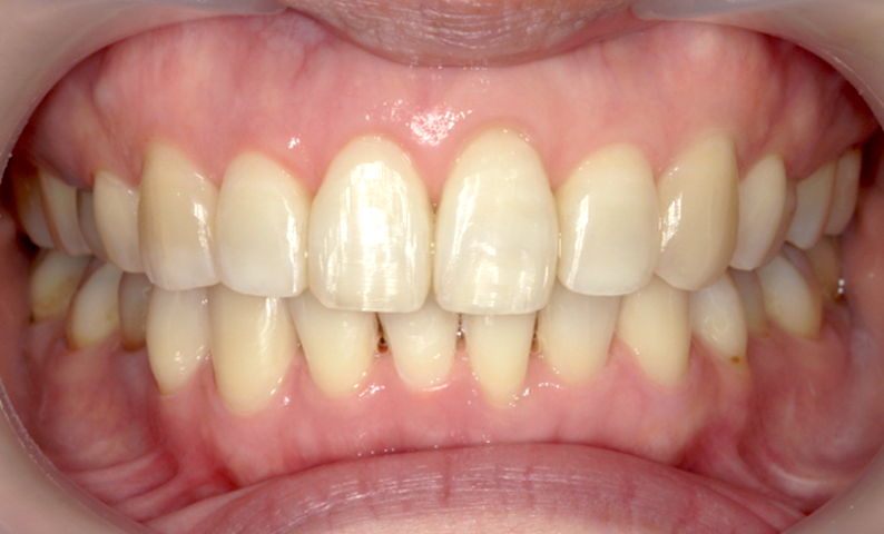 部分矯正 40代の症例写真