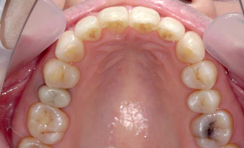 部分矯正 40代の症例写真