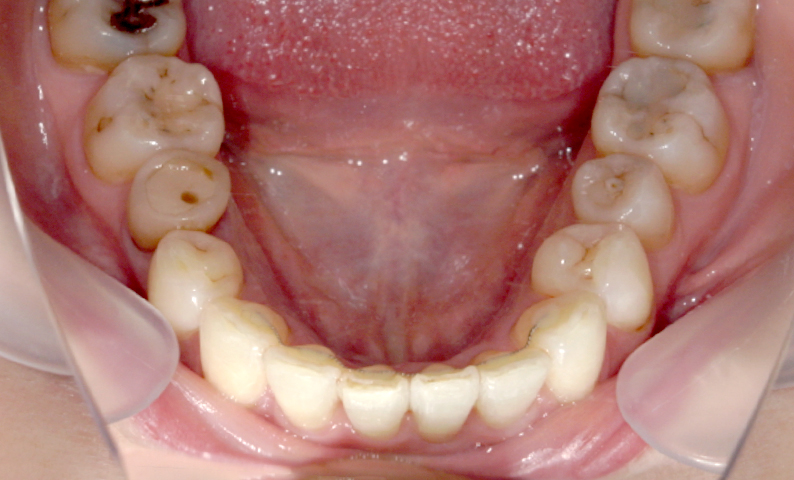 部分矯正 40代の症例写真