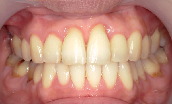 部分矯正 40代の症例写真