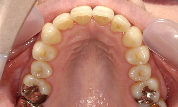 部分矯正 40代の症例写真