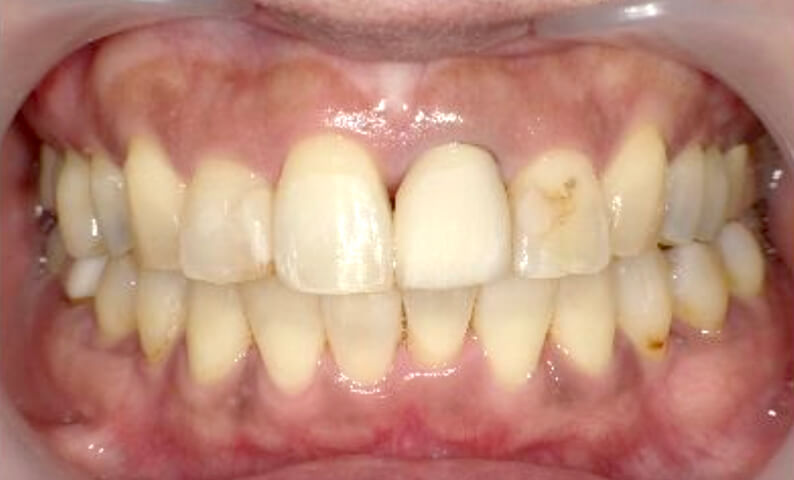部分矯正の症例 前歯のガタガタ