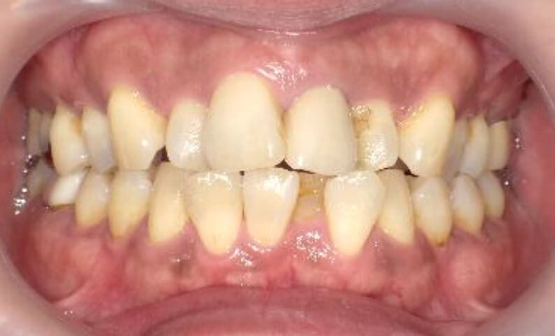 部分矯正の症例 前歯のガタガタ