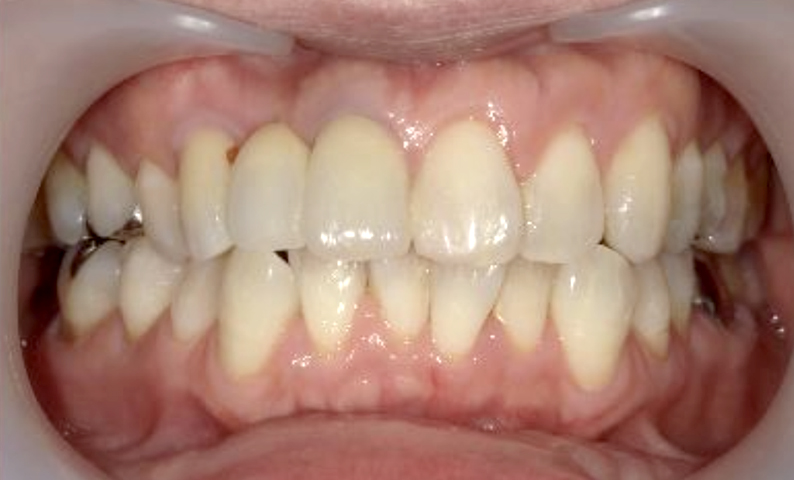 部分矯正 50代の症例写真