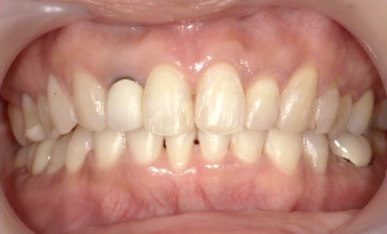 部分矯正 50代の症例写真