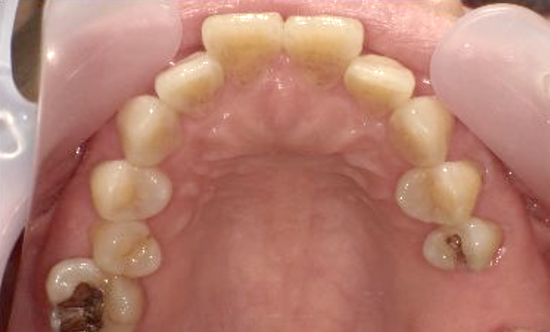 部分矯正 50代の症例写真