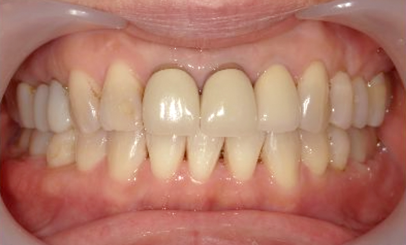 部分矯正 50代の症例写真