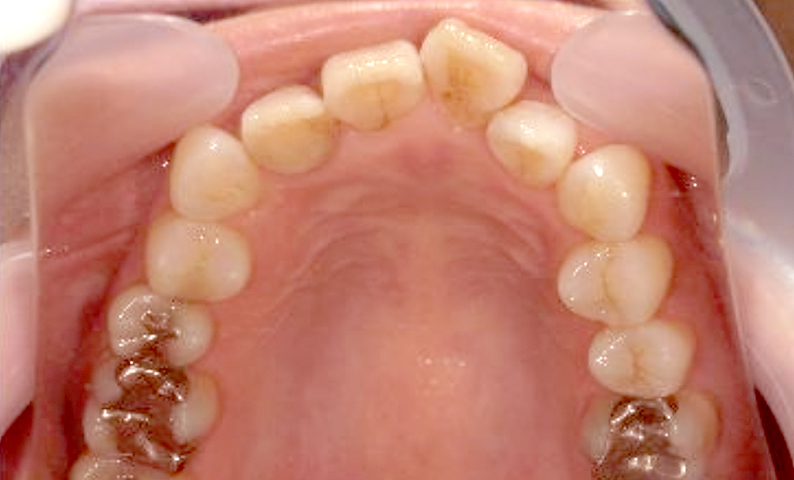 部分矯正 50代の症例写真