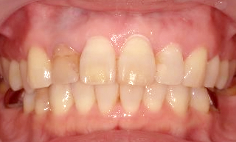 部分矯正 50代の症例写真