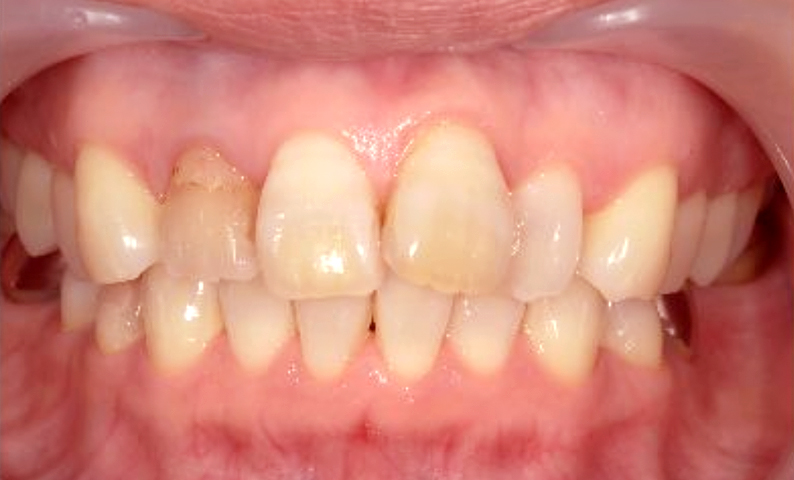 部分矯正 50代の症例写真