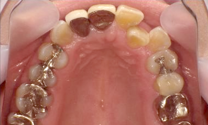 部分矯正 50代の症例写真