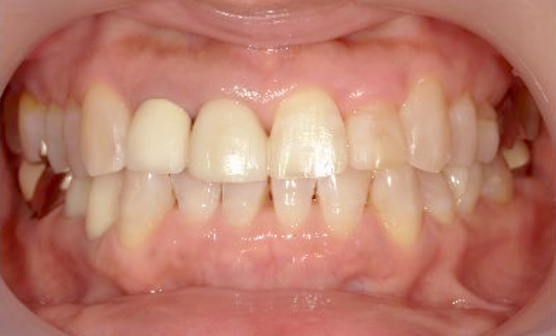 部分矯正の症例 八重歯