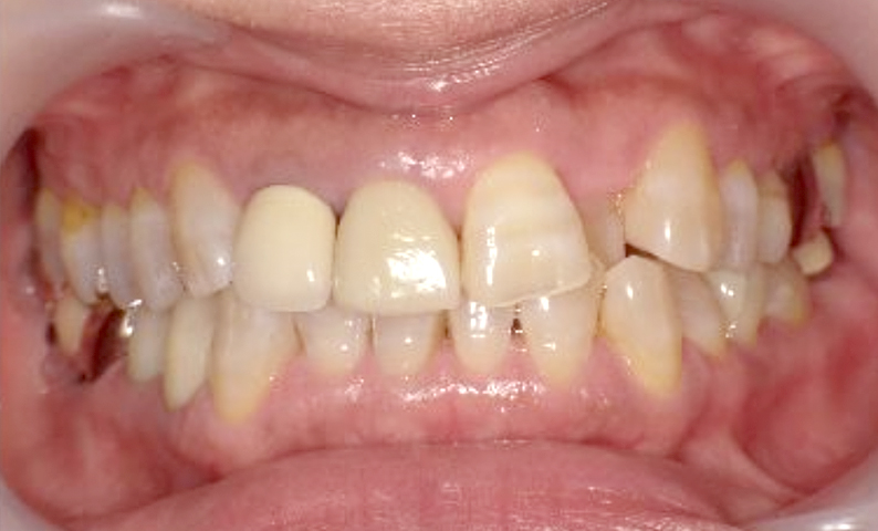 部分矯正の症例 八重歯