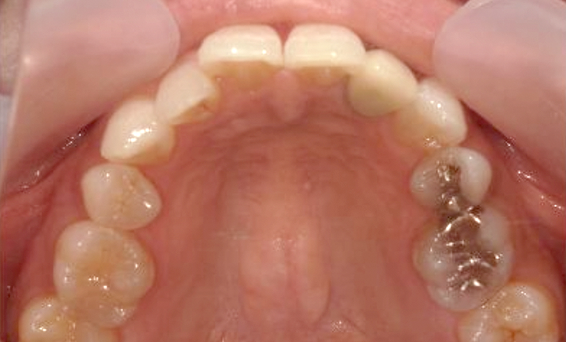 部分矯正 50代の症例写真