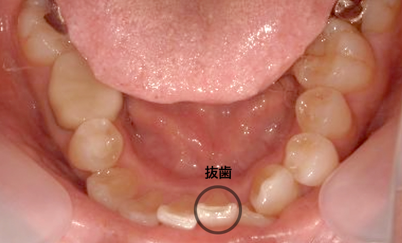 部分矯正 50代の症例写真
