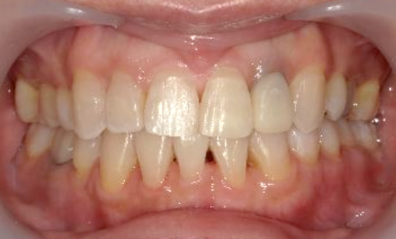 部分矯正 50代の症例写真