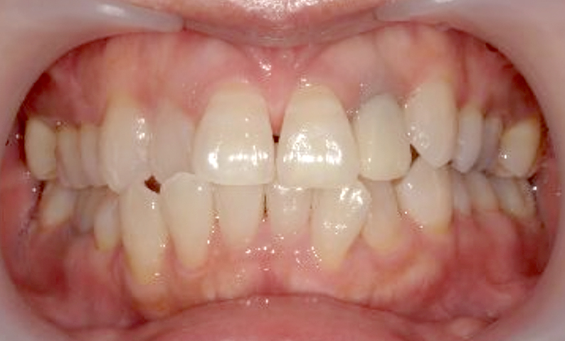 部分矯正 50代の症例写真