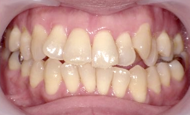 部分矯正 50代の症例写真