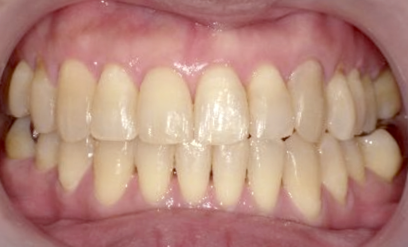 部分矯正 50代の症例写真