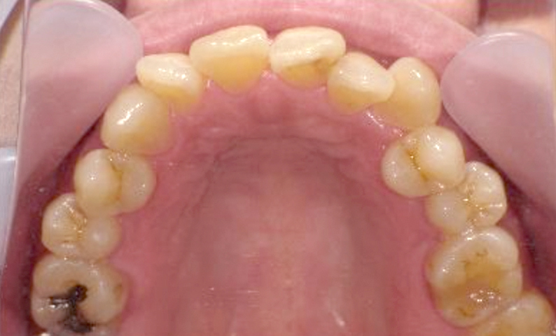 部分矯正 50代の症例写真