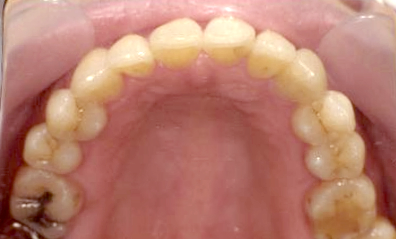 部分矯正 50代の症例写真