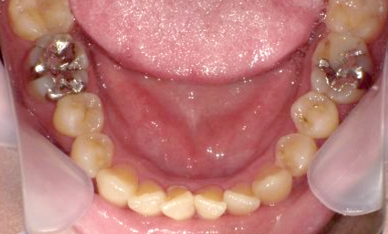 部分矯正 50代の症例写真