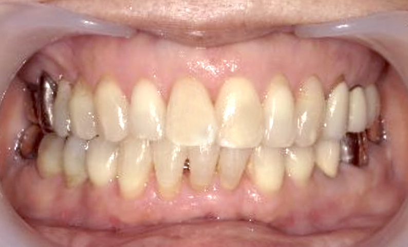 部分矯正 50代の症例写真