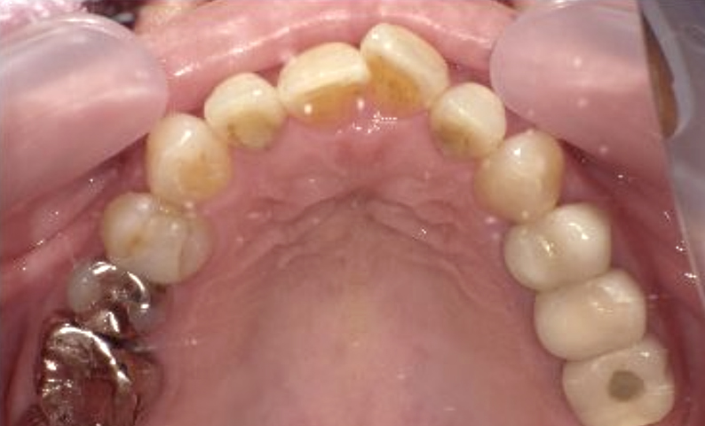 部分矯正 50代の症例写真