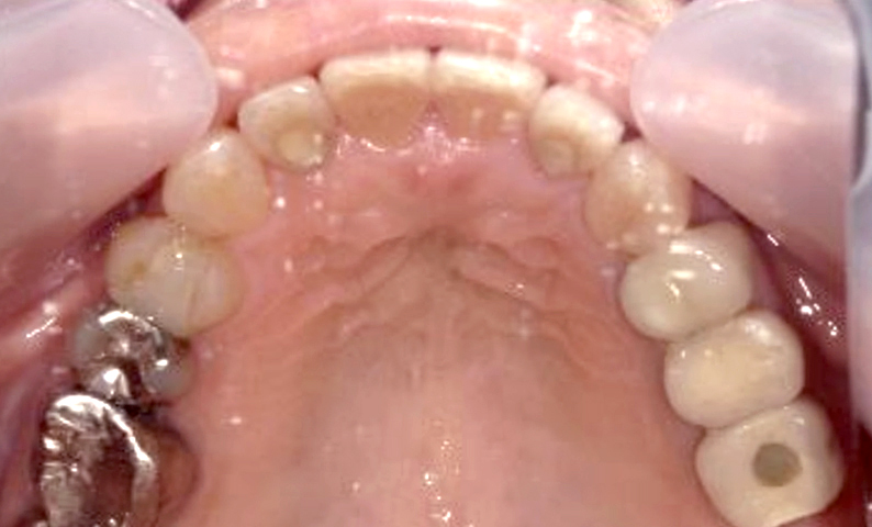 部分矯正 50代の症例写真