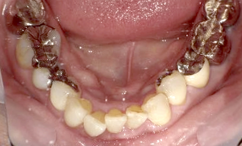 部分矯正 50代の症例写真