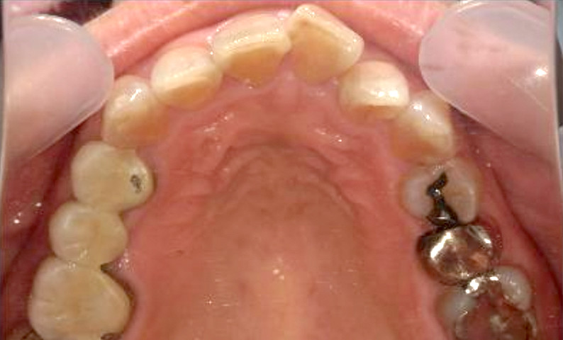 部分矯正 50代の症例写真