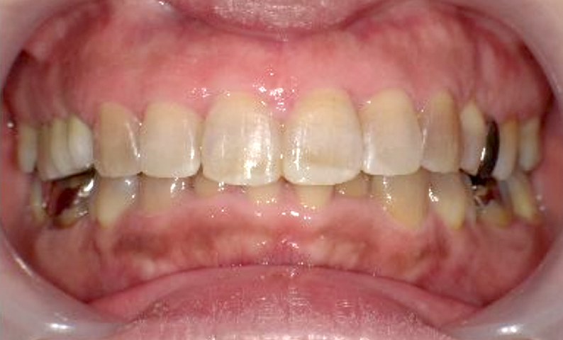 部分矯正 50代の症例写真