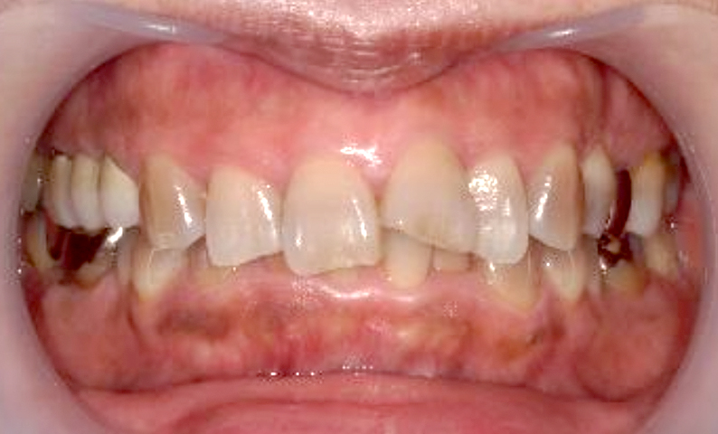 部分矯正 50代の症例写真