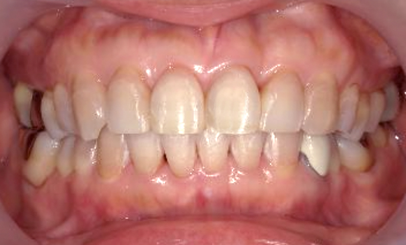 部分矯正 50代の症例写真