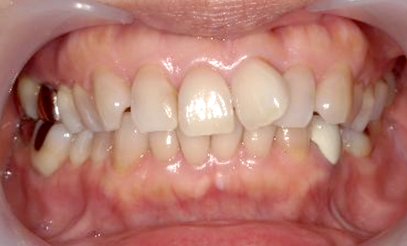 部分矯正 50代の症例写真