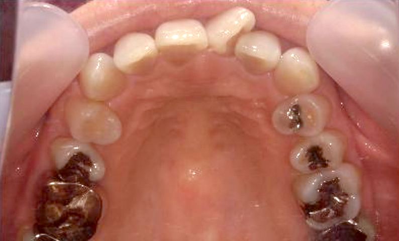 部分矯正 50代の症例写真