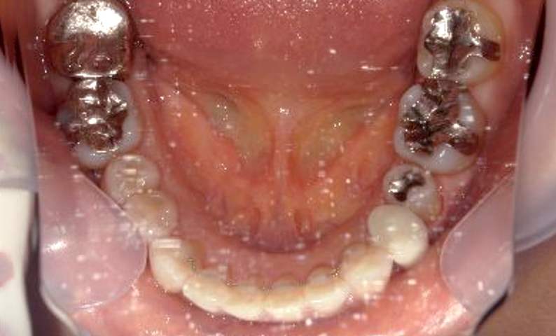 部分矯正 50代の症例写真