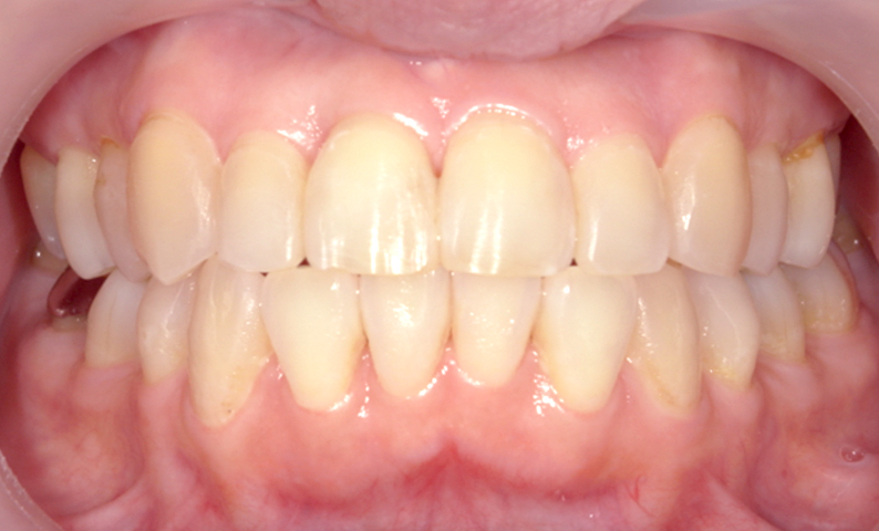 部分矯正 50代の症例写真