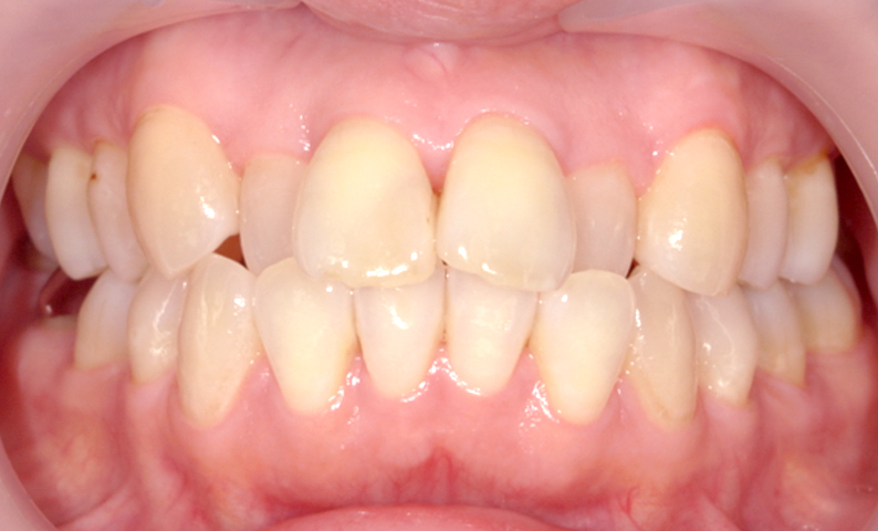 部分矯正 50代の症例写真