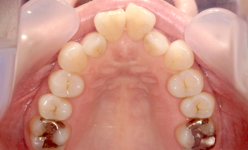 部分矯正 50代の症例写真